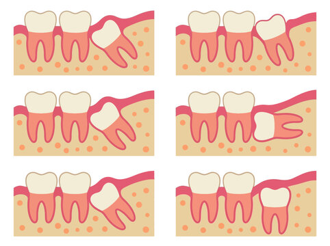Types of Impacted Wisdom Teeth Vector Diagram
