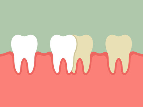 Dental whitening comparison illustration with healthy and stained teeth
