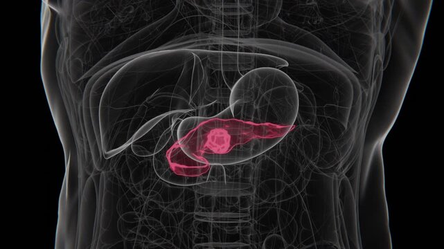 Pancreatic cancer is a malignant tumor that develops in the pancreas, an organ involved in digestion and blood sugar regulation in 4K UHD