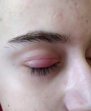 close up of ill male eye