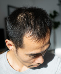 Fototapeta premium Thinning hair male adult close up natural light receding hairline black hair Asian casual indoor sunlight worried expression scalp hair loss lifestyle home daytime short hair healthy skin portrait