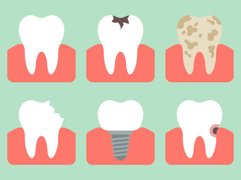 Dental health icons set illustrating healthy tooth, cavity, decay, broken tooth, implant, and gum inflammation.