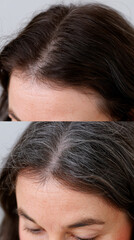 Fototapeta premium Exosomes for Hair Growth – Before and After Hair Density Assessment