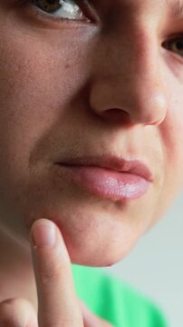 Close-up of a young woman inspecting and touching a pimple on her chin. Skin care, acne problem, dermatology, and aesthetic blemish concept. PMS woman