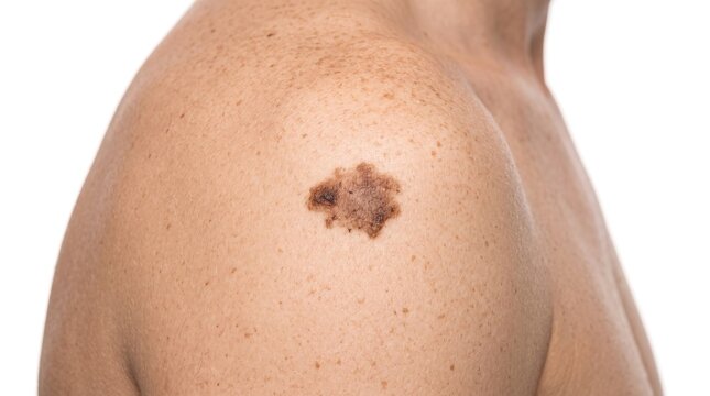 Melanoma active skin cancer on shoulder close up
