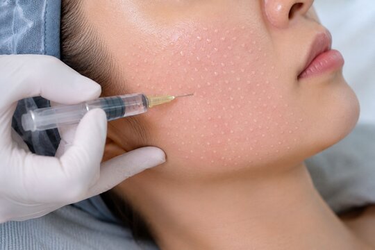 Close up syringe injecting mesotherapy solution into man's cheek and jaw area