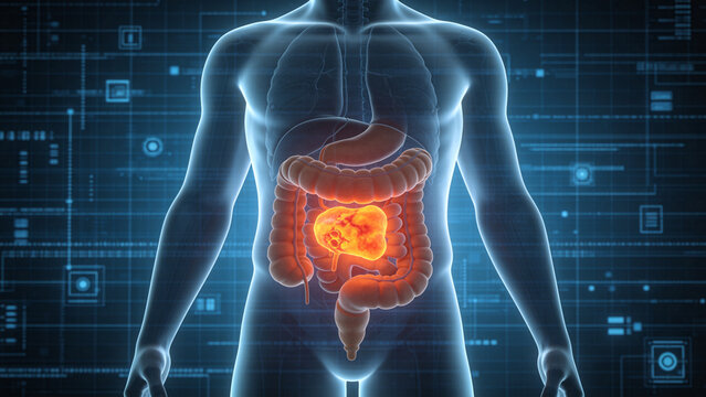 Colorectal Cancer: Malignant Tumor Lesion of Human Colon and Rectum, 3D Medical Anatomical Illustration of Large Intestine Organ