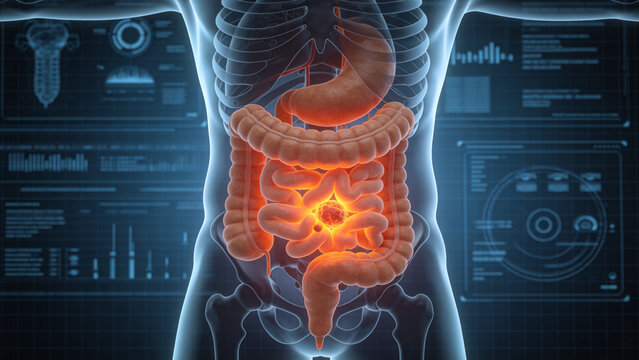 Colorectal Cancer: Malignant Tumor Lesion of Human Colon and Rectum, 3D Medical Anatomical Illustration of Large Intestine Organ