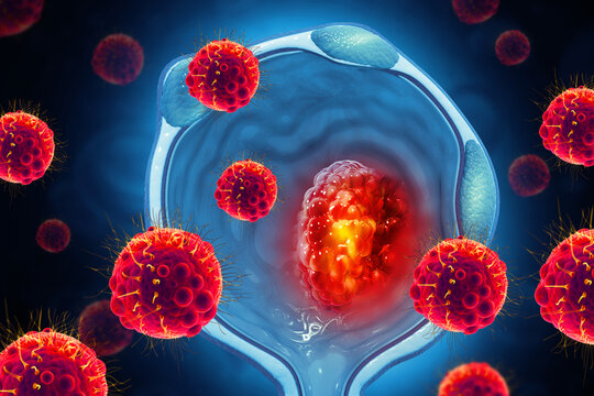 Prostate disease, Benign prostatic hyperplasia (BPH), Prostate cancer. 3d illustration