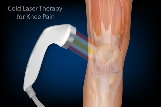 Cold Laser Therapy for Knee Pain Medical Anatomy Illustration. Low Level Laser Therapy for Knee Joint Pain and Rehabilitation