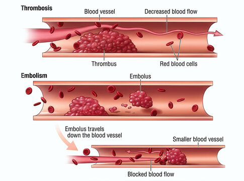 Medical illustration comparing thrombosis and embolism, showing a blood clot forming within a vessel and a detached embolus traveling through the bloodstream to block a narrower vessel.