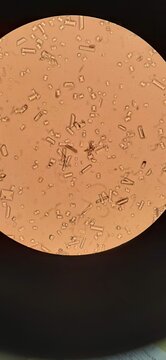 Triple phosphate crystals in urine sediment under microscope in clinical laboratory