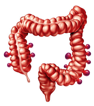 Symptomatic Diverticular Disease with colonic diverticula as small pouch like protrusions that form in the wall of the colon resulting in Abdominal pain and crampin