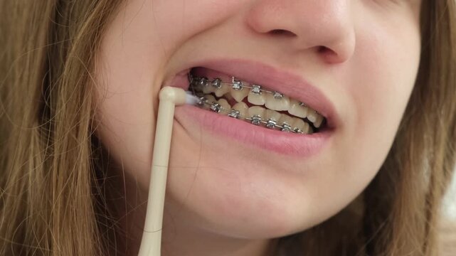 Close up teen girl with braces brushing her teeth with mono tuft toothbrush. Orthodontic treatment, dental and oral care concept