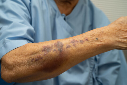 Ecchymosis, elderly bleeding on her arm after taking aspirin.