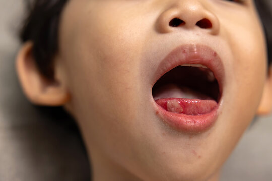 Sick child with hand foot and mouth disease showing red rash and skin lesions on the hands and feet, with a caregiver examining the symptoms and providing home care.