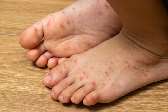 Sick child with hand foot and mouth disease showing red rash and skin lesions on the hands and feet, with a caregiver examining the symptoms and providing home care.
