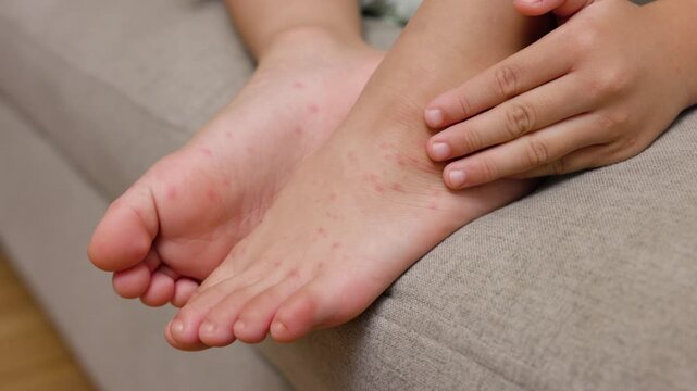 Child with hand foot and mouth disease showing red rashes on hands and feet