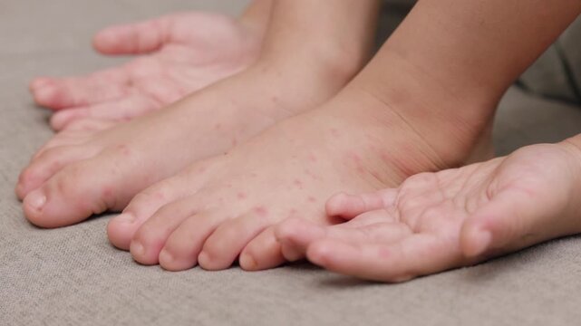 Child with hand foot and mouth disease showing red rashes on hands and feet