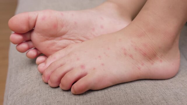 Child with hand foot and mouth disease showing red rashes on hands and feet