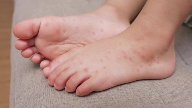 Child with hand foot and mouth disease showing red rashes on hands and feet