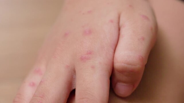 A sick child with hand foot and mouth disease showing red rash and skin lesions on the hands and feet, with a caregiver examining the symptoms and providing home care.
