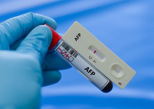 Blood sample tube of patient negative result for alpha fetoprotein (AFP).