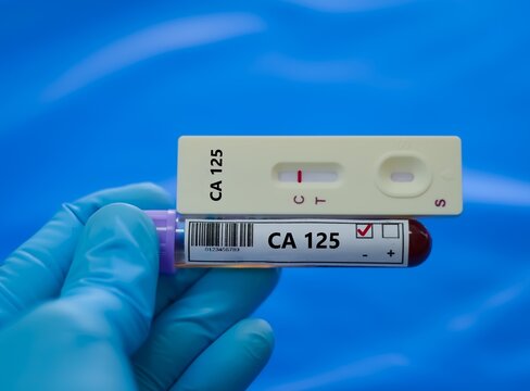 Blood sample of patient negative result for CA 125.