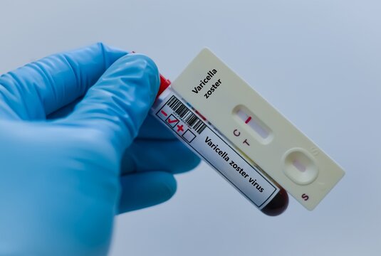Blood sample of patient negative result for varicella zoster virus.