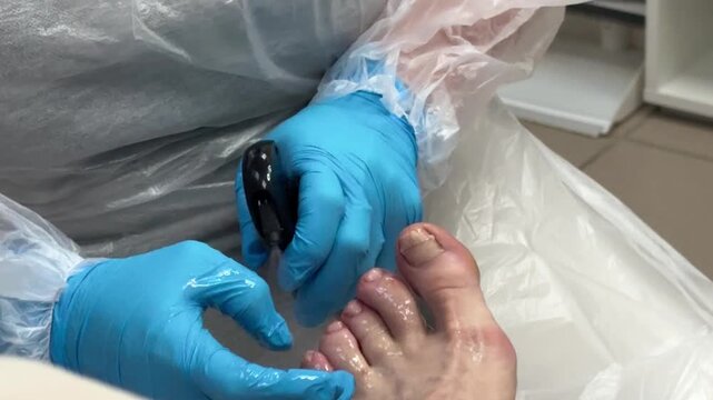 Nail plate treatment and ingrown nail correction in a clinical setting  