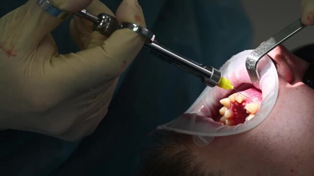Dentist administers local anesthesia to the gum or tooth area using a dental syringe. Dental mirror is used alongside to retract cheek and provide view of  treatment area. Patient receives anesthesia 