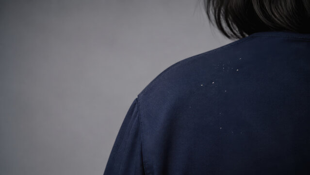 Dandruff flakes on dark blue shoulder jacket, personal hygiene and hair health problem