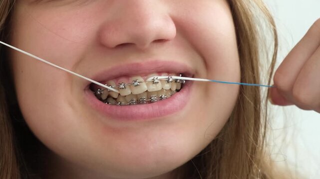 Closeup teen girl with braces cleaning teeth using dental floss. Dental hygiene and orthodontic treatment concept