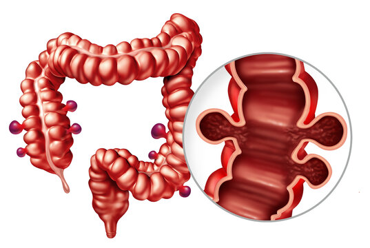 Diverticulosis Disease With Colonic Diverticula  and Symptomatic Diverticular illness with colonic diverticula as small pouch like protrusions that form in the wall of the colon resulting in Abdominal
