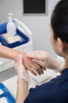 Clinician treating minor hand burn with cooling hydrogel dressing