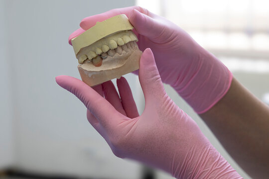 Close-up of a dental professional holding a plaster jaw model with a removable partial denture in occlusion. Demonstration of prosthetic tooth replacement and dental restoration in a clinical setting.