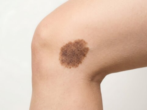 Close up view of a large brown birthmark or mole on a person human knee skin