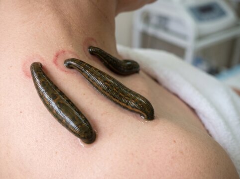 Medical leeches attached to human skin during alternative therapy procedure