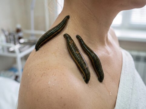 Medical leeches on human shoulder and neck during alternative treatment session