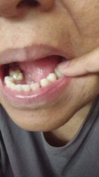 finger activity indicating that the tooth is starting to become loose