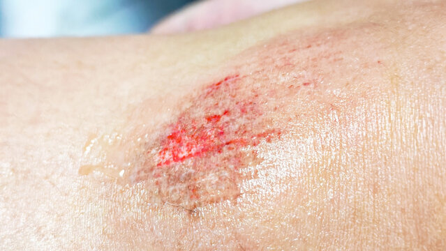 Close-up of a Raw Abrasion on Skin: A macro shot revealing the raw, red surface of a scraped knee or elbow. Macro shot of wound scratch on skin applying antiseptic medicine.