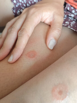 two insect bites on a person's body