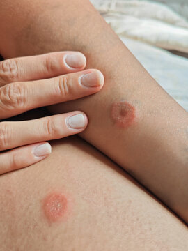 insects bites on a person's body