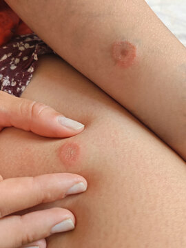 insects bites on a person's body