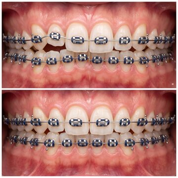 Teeth Alignment Progress During Orthodontic Treatment with Traditional Metal Braces