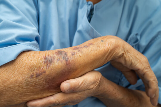 Ecchymosis, elderly bleeding on her arm after taking aspirin.