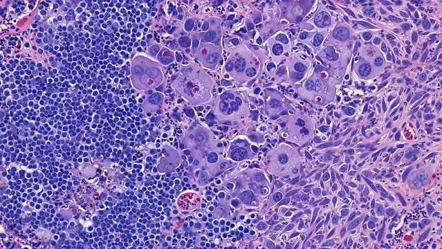 Heterogeneous cancer tumor histology featuring diverse malignant cell types including small round blue cells large pleomorphic cells and spindle-shaped cells with varied nuclear features