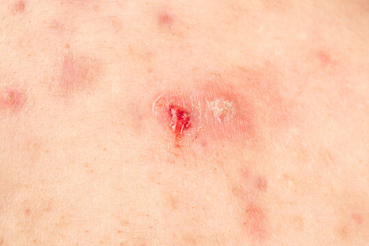 Abscess lesion on infected skin. Boil with visible pus. Skin abscess macro for dermatology. Purulent drainage near red epidermis.