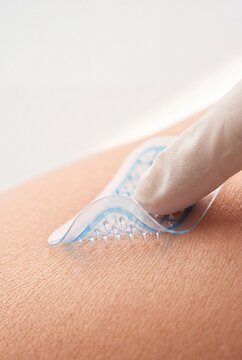 Gloved Finger Applying Innovative Dissolving Microneedle Patch on Human Skin for Painless Drug Delivery