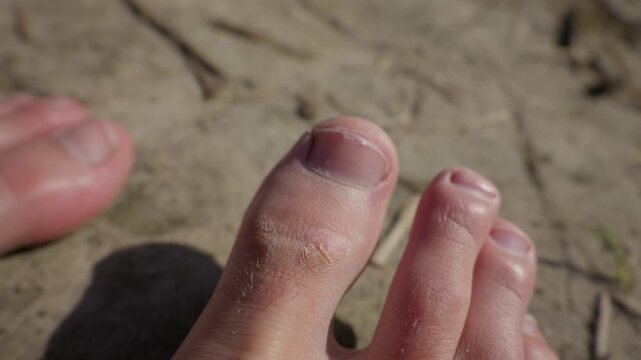 Dry cracked human toes rest on arid desert ground in harsh daylight. Rough calloused skin and damaged cuticles highlight foot dehydration. The textured earth creates strong contrast.